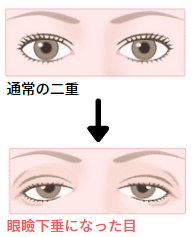 通常の二重　と　眼瞼下垂になった目の比較