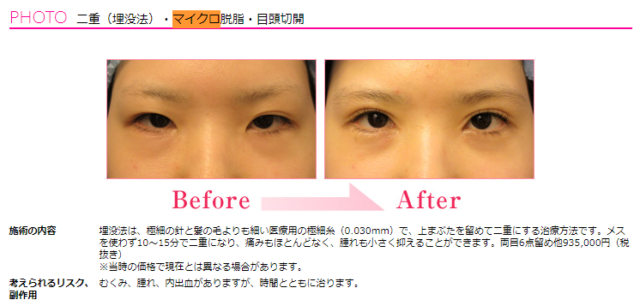 目の上の脂肪取り、厚み取りの手術 症例写真
