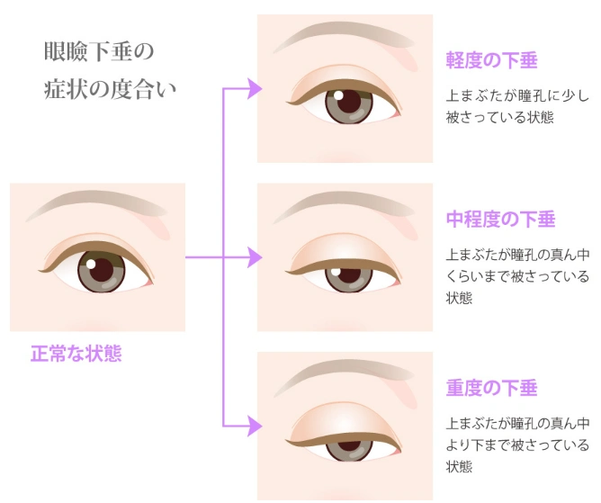 眼瞼下垂とは　東京中央美容外科