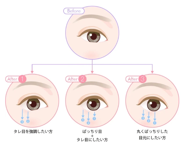 タレ目形成とは　グラマラスライン形成とは　下眼瞼下制とは
